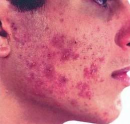 Acne Pictures, Images and Photos